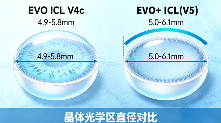 国庆摘镜:一文读懂 ICL V5,摘镜为什么选它?